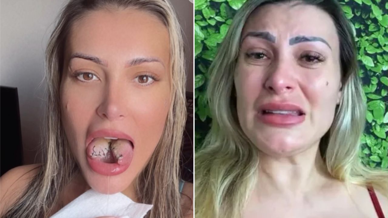 Enfrentando Dificuldades Após Bifurcar a Língua, Andressa Urach Toma ‘Atitude Desesperada’