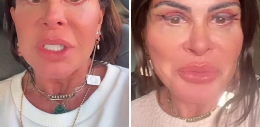 Gretchen Enfrenta Cirurgia Delicada no Rosto para Evitar Necrose: ‘A Gente Removeu…’